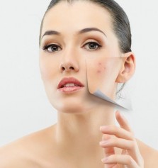 Cmo cuidar la piel con acn