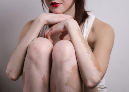 Es hereditario el vitiligo?