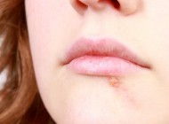 Salud: Causas de las calenturas en los labios