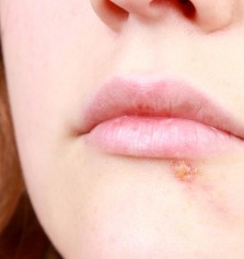 Salud: Causas de las calenturas en los labios