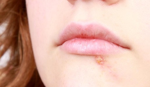 Salud: Causas de las calenturas en los labios