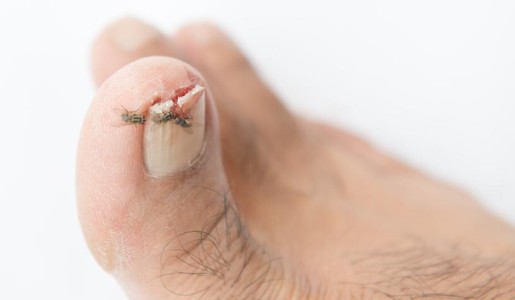 Cómo tratar una uña golpeada