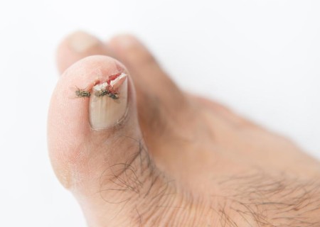 Cómo tratar una uña golpeada