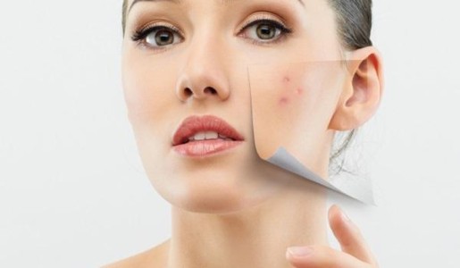 Cómo cuidar la piel con acné