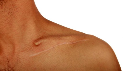 Cómo quitar cicatrices de heridas