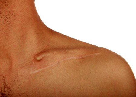 Cómo quitar cicatrices de heridas