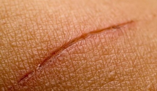 Cómo limpiar una herida