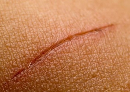 Cómo limpiar una herida