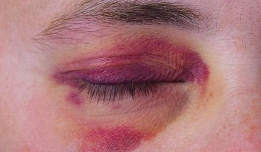 Cómo curar un moretón en el ojo