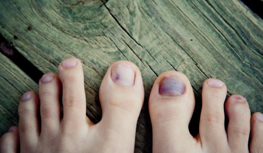 Cómo tratar una uña morada