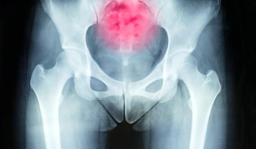 Cuáles son los síntomas de un quiste pilonidal