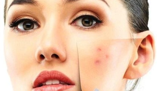 Cómo tapar los granos con maquillaje