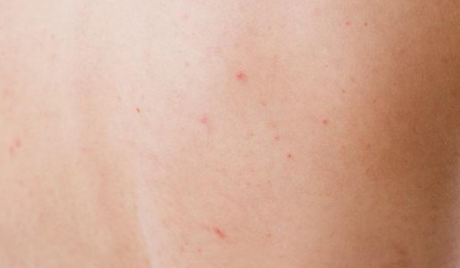 Cómo quitar el acné de la espalda