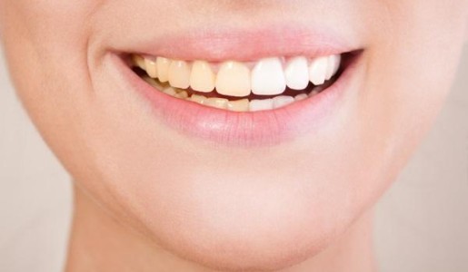 Por qué tengo los dientes amarillos