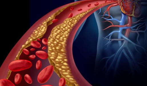 Cuáles son las causas de la arteriosclerosis